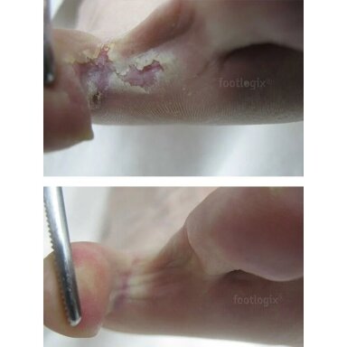 Priešgrybelinė priemonė Footlogix - Peeling Skin Formula 125ml